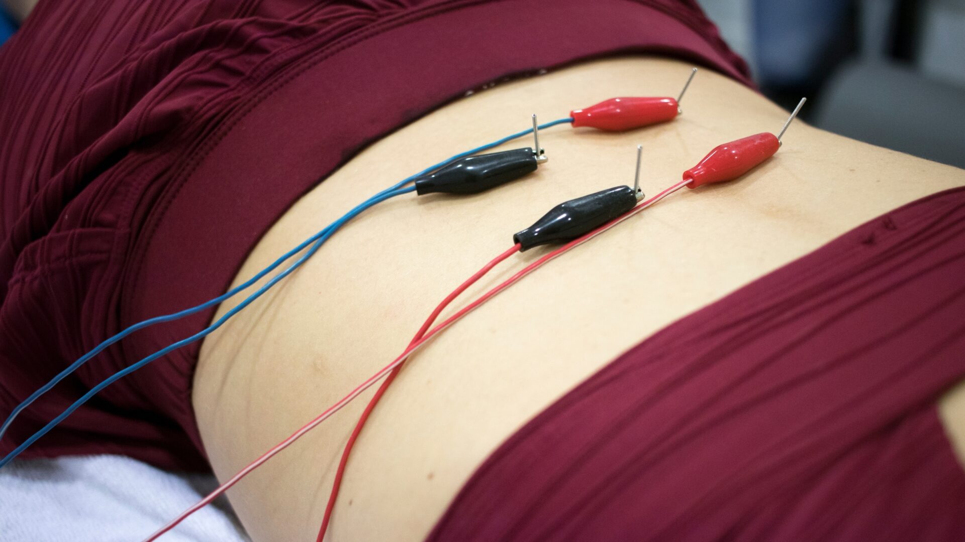Close up of a person getting dry needling done with electrical stimulation