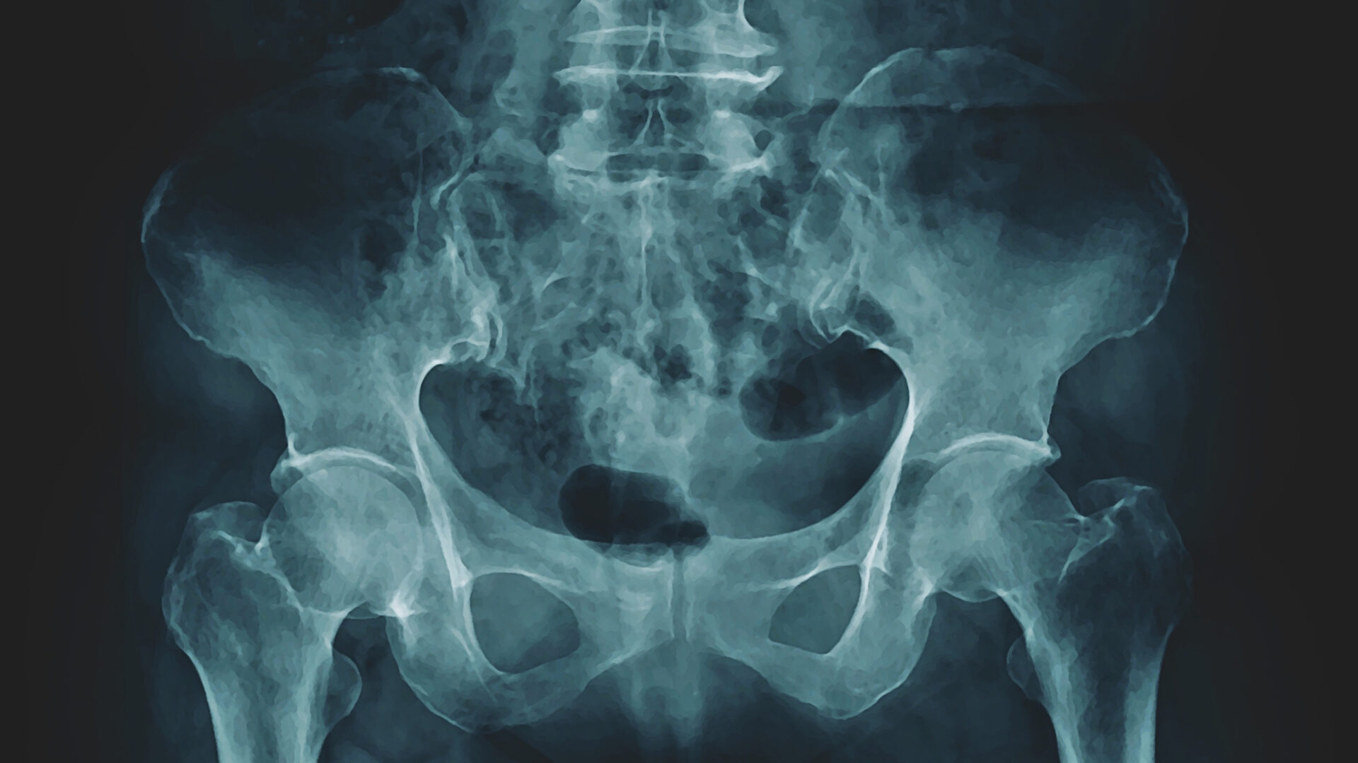 X-ray of a pelvis.